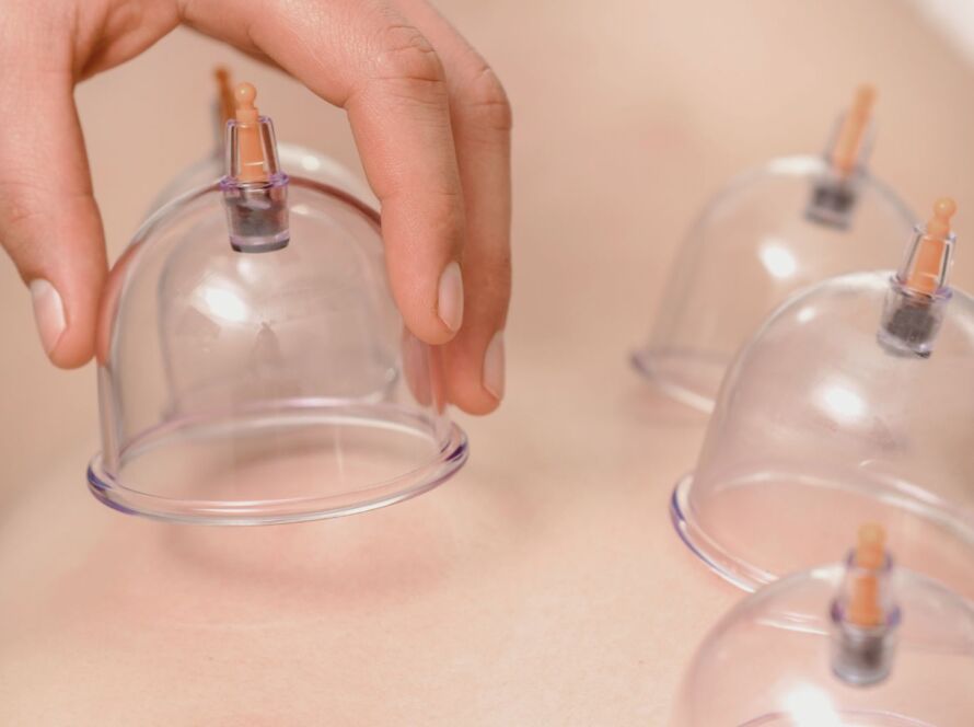 Cupping therapy treatment in Torrevieja for muscle pain relief and improved circulation
